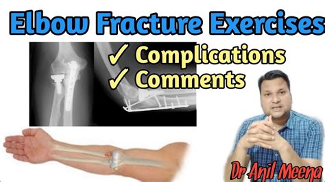 Elbow Fracture Recovery Exercises Elbow Fracture Exercise Post