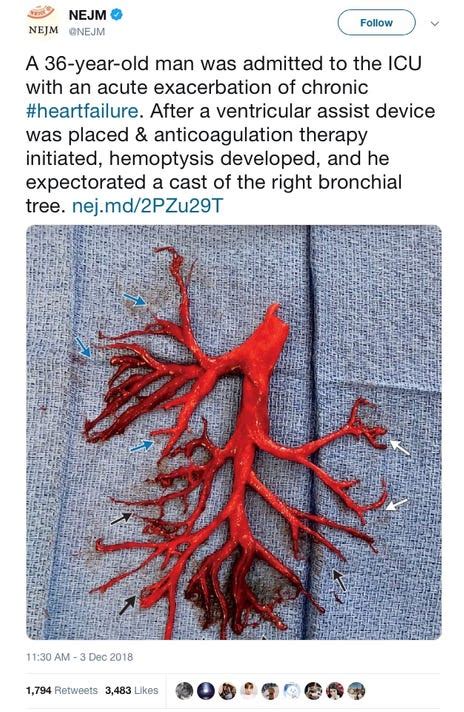 Nejm Shares Odd Photo Of Blood Clot Shaped Like Lung A Man Spit It Up