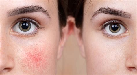 How Do You Get Rid Of Broken Blood Vessels On Your Face Healthnews