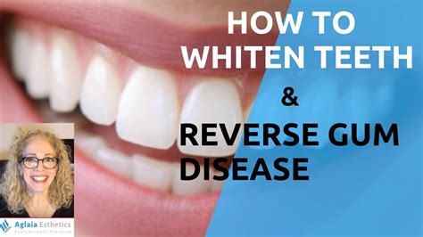 How To Whiten Teeth And Reverse Gum Diseases Naturally Youtube