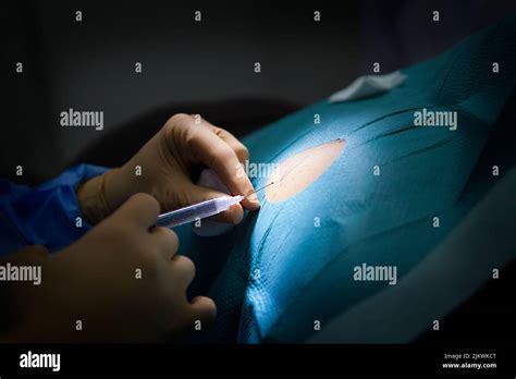 Anesthesia For Removal Of A Cyst In A Dermatology Practice Stock Photo