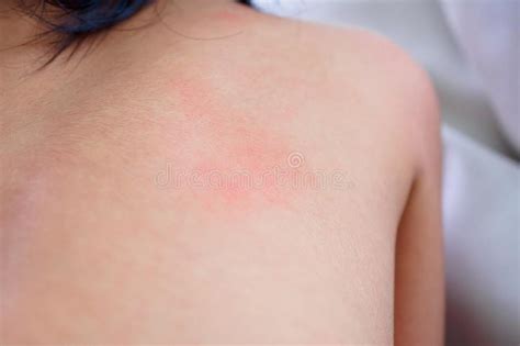 Girl Skin Rash And Allergy With Red Spot Cause By Mosquito Bite At Back