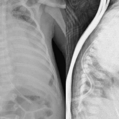 Frontal And Lateral Decubitus Chest X Rays Demonstrate Large Lobulated