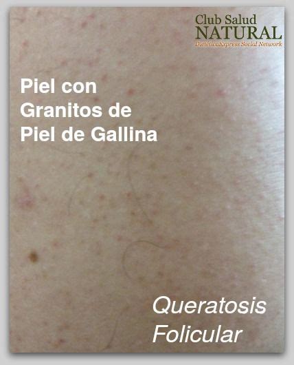 Piel Con Granitos De Piel De Gallina Qu Es La Queratosis Pilaris Club Salud Natural Piel