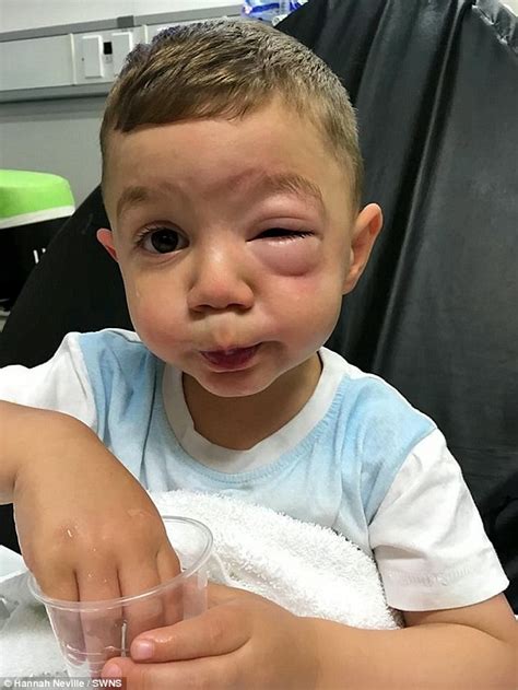 Boys Face Is Left Swollen After He Suffers Severe Allergic Reaction