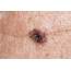 Skin Cancer Symptoms How To Check For Moles  Reader’s Digest