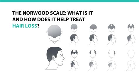 The Norwood Scale What Is It And How Does It Help Treat Hair Loss