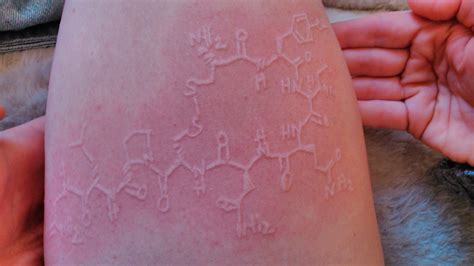 Dermatographic A Forum For Sharing About Dermatographia