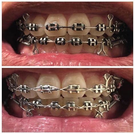 Braces Girlswithbraces Metalbraces Loops Teeth Braces Metal