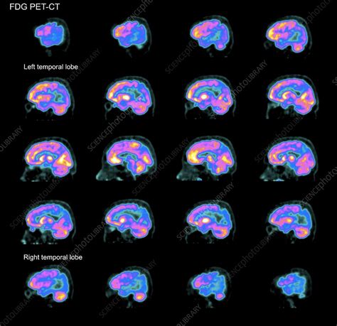 Alzheimers Disease Pet Brain Scans Stock Image C0388790