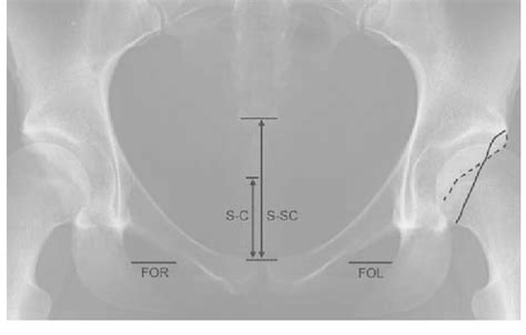weightbearing anteroposterior pelvic radiograph is shown ssc the download scientific diagram