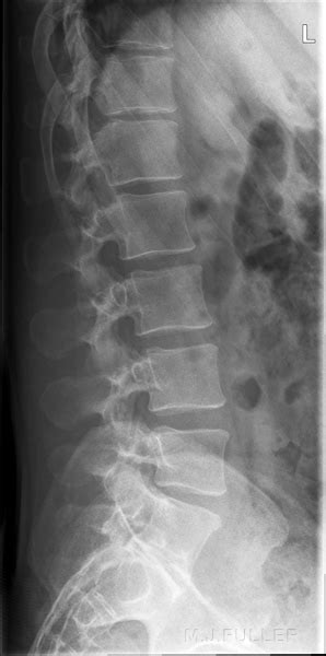 Lateral Lumbar Spine Radiography Wikiradiography