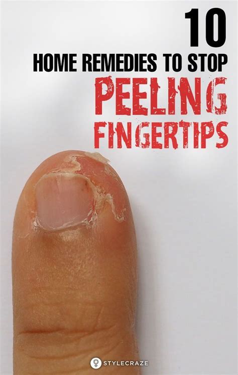 10 Effective Home Remedies To Stop Peeling Of The Fingertips Artofit