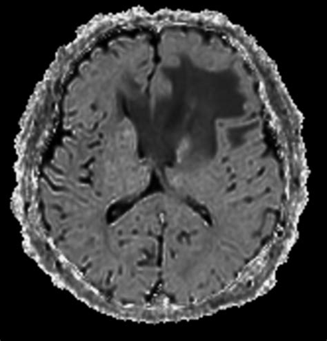 Advanced Imaging Of The Brain Philips Mr Body Map