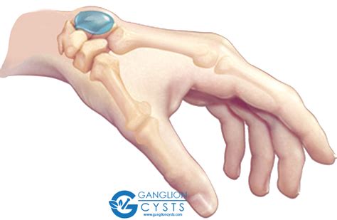 Ganglion Cysts Information Treatments And Remedies
