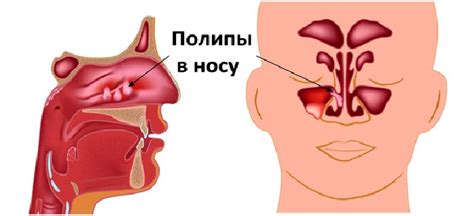 Полипы в носу у ребенка симптомы лечение признаки