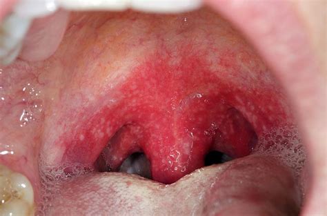 Is Strep A Bacterial Infection