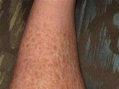 Routine Help Seriously Dry Scaly Looking Shins How To