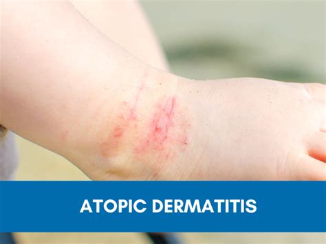 Atopic Dermatitis Signs And Symptoms Eczema Signs And Symptoms