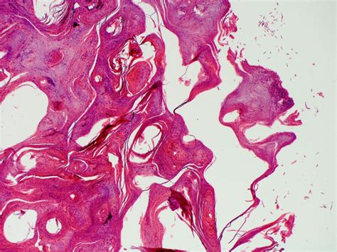 Rupioid Psoriasis Presents With Extensive Hyperkeratotic Plaques Bmj