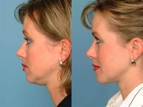 Double Chin Liposuction Price How Do You Price A Switches