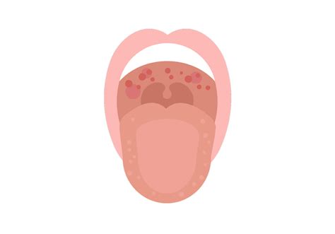 Painless Red Spot On Tongue