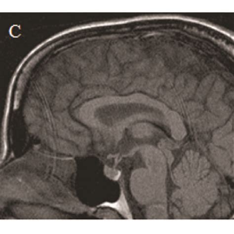 A B Pre And Postcontrast Brain Mri Images Of Case 1 Show That