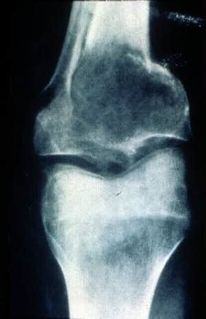 Treatment options for osteosarcoma in cats in most cases of osteosarcoma in the legs, the primary treatment recommended by your vet is amputation. Bone Cancer in Dogs and Cats