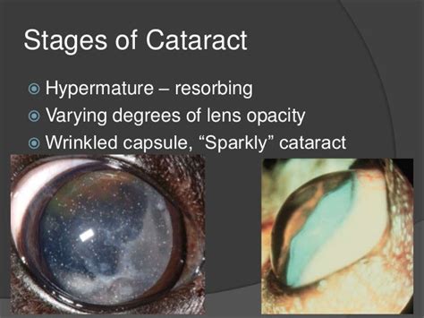 Cataracts Dr Christa Corbett 11814