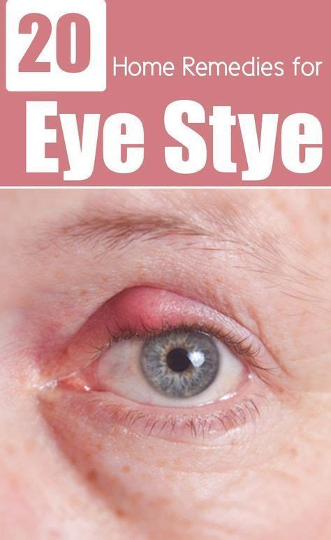 26 Effective Home Remedies To Get Rid Of Eye Stye Natural Home