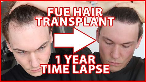FUE Hair Transplant Timeline 1 YEAR Day 1 365 12 Months Progress