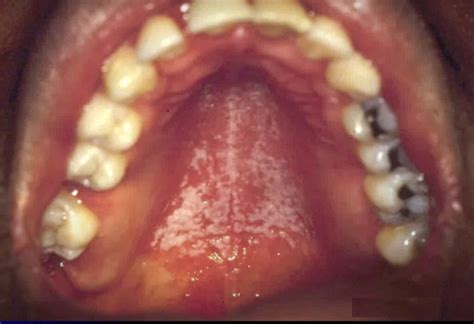 HIV Tongue See Pictures Identify Symptoms At Every HIV Stage STD