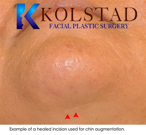 Photo Gallery Eyelid And Browlift Del Mar Dr Christopher Kolstad