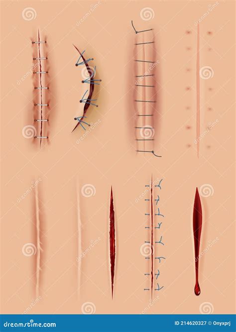 Realistic Scars Medical Surgical Sutures Wounds Close Up Pictures On