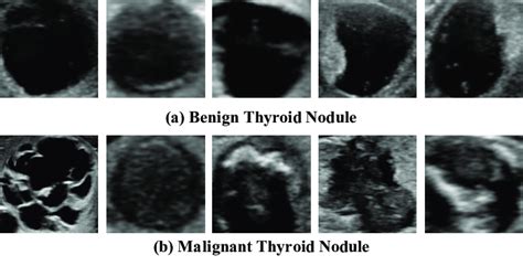 Some Examples Of Benign And Malignant Thyroid Nodules In Ultrasound