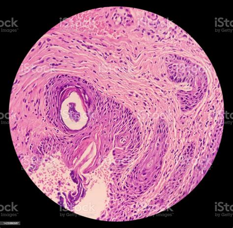 Punch Biopsy Of Face Skin Face Skin Carcinoma Pigmented Basal Cell