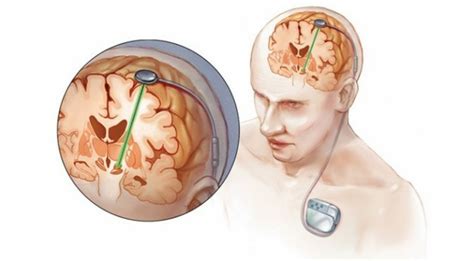 What Are The Complications Of Deep Brain Stimulation Surgery Jagtap Clinic And Research Centre