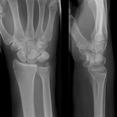 Splinter Series A Case Of Traumatic Wrist Pain After Fall On