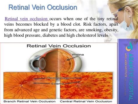 Retinal Vein Occlusion Sudden Painless Loss Of Vision Often