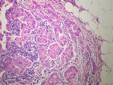 Invasive Micropapillary Carcinoma Of The Breast Libre Pathology