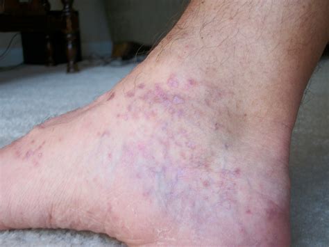 Red Rash On Tops Of Feet Pictures Photos