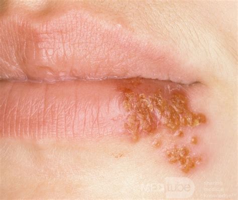 Herpes Simplex Lower Lip Resolving • Picture •