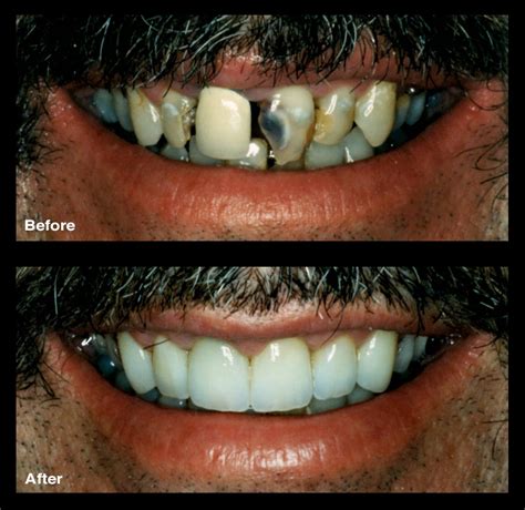 Dental Bonding Broken Decayed Teeth Signature Smiles Ga