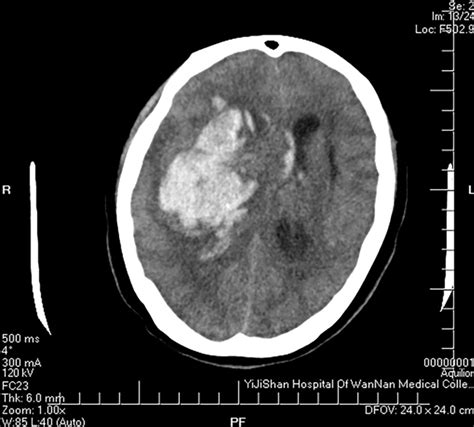 Cranial Computed Tomography Scan Showing Right Basal Ganglia Region