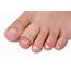 Hammer Toe  Causes Diagnosis And Treatment The Foot Hub