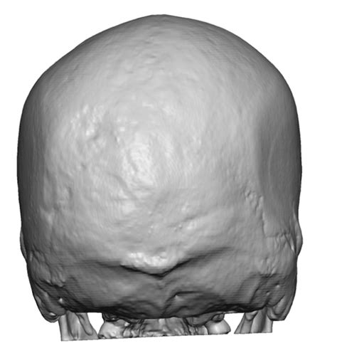 Skull Reshaping Plastic Surgeon Dr Barry L Eppley Md