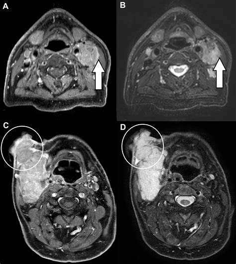 Radiological Assessment Of Extranodal Extension In Patients With Head