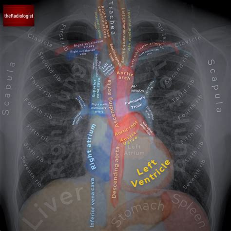 Labeled Chest X Ray Anatomy By Dr Naveen Sharma Radiology