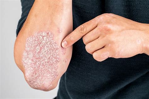 4 Psoriasis Triggers To Avoid For Clearer Skin The Center For