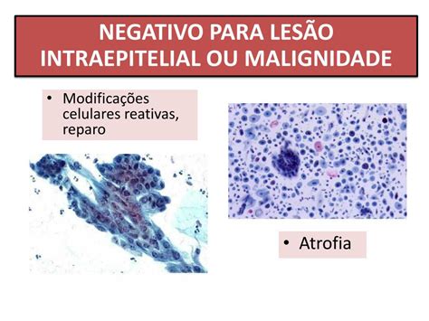 Negativo Para Lesão Intraepitelial Ou Malignidade Na Amostra Analisada